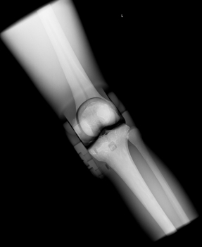 Röntgen-Teilphantom mit künstlichen Knochen - Rechtes Knie, opak