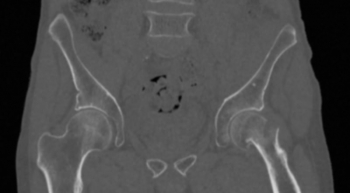 Becken-Phantom mit Schenkelhalsfraktur für CT, Röntgen und Strahlentherapie