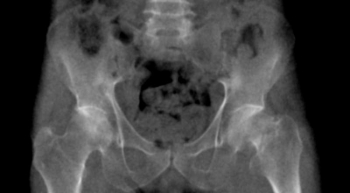 Becken-Phantom mit Schenkelhalsfraktur für CT, Röntgen und Strahlentherapie