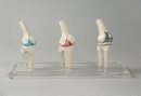 Knie Implantat Modell