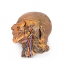 Sagittalschnitt von Kopf und Hals mit Infratemporalfossa und Karotisscheibendissektion